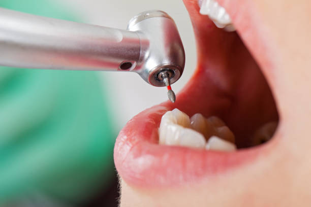 Best Emergency Wisdom Teeth Removal in Livermore, CA